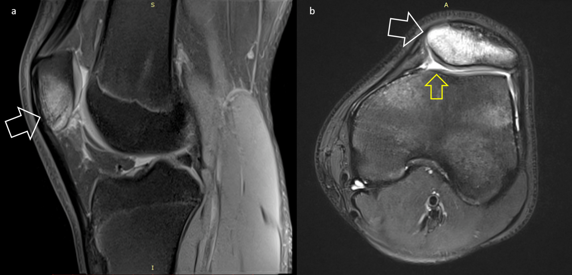 Patella Anatomy Mri