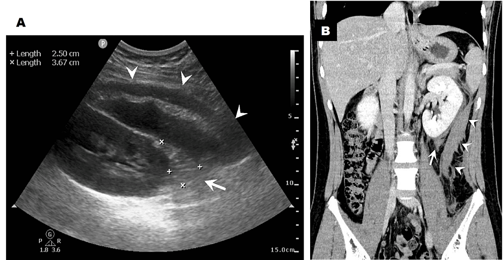 Postrenal Biopsy Retroperitoneal Haematoma by Decreased