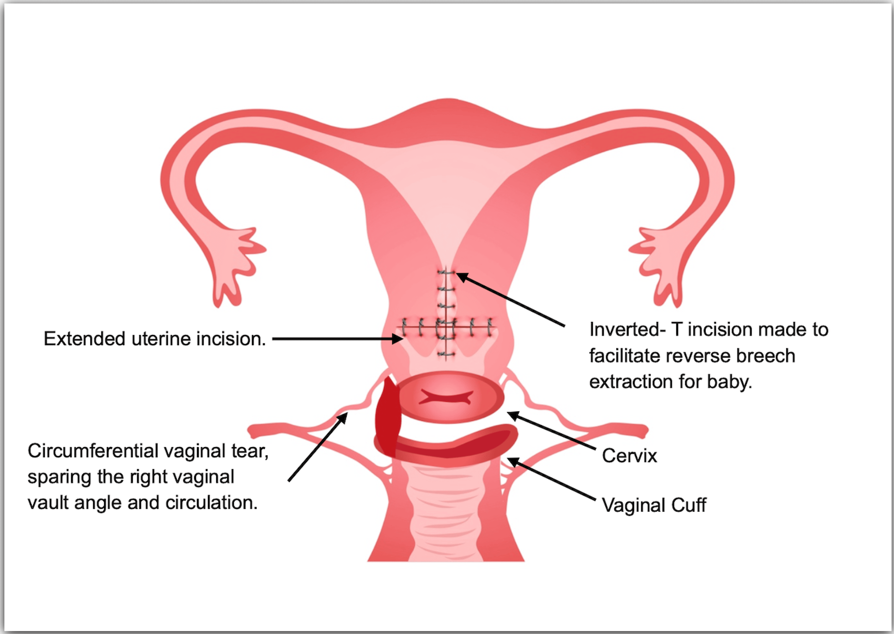 Cureus Circumferential Vaginal Tear During the Cesarean Section A Complication of Vaginal