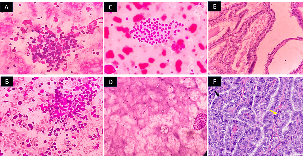 Chọc vọng-tế bào học-hình ảnh-của-ba-đại diện-bệnh nhân-với-tuyến giáp-nốt sần.-Panels-A-and-B:--Lymphocytic-thyroiditis-(The-Bethesda-System-for-Reporting-Thyroid-Cytology-(TBSRTC)-II)-in-representative-case-1—(A)-Lymphocytes-infiltrating-follicular-epithelial-cells-(H&E,-10X),-and-(B)-Lymphoid-cells-of-varying-stages-of-maturation-infiltrating-follicular-epithelial-cells-(H&E,-10X);-Panels-C-and-D: -Colloid-bướu cổ-(TBSRTC-II)-in-representative-case-2—(C)-Flat-sheets-with-evenly-spaced-follicular-cells,-with-pigment-laden-macrophages-(H&E,10X),-and-(D)-A-follicular-cell-cluster-with-a-watery-thin-colloid-background-(H&E,-10X);-Panels-E-and-F:-Papillary-thyroid-carcinoma-(TBSRTC-IV)-in-representative-case-3—(E)-True-papillary-fronds-(H&E,-10X)-with-(F)-pronounced-nuclear-features-include-nuclear-grooving-(mũi tên đen),- chồng chéo và xóa - (mũi tên màu vàng) - (H &E, -40X).