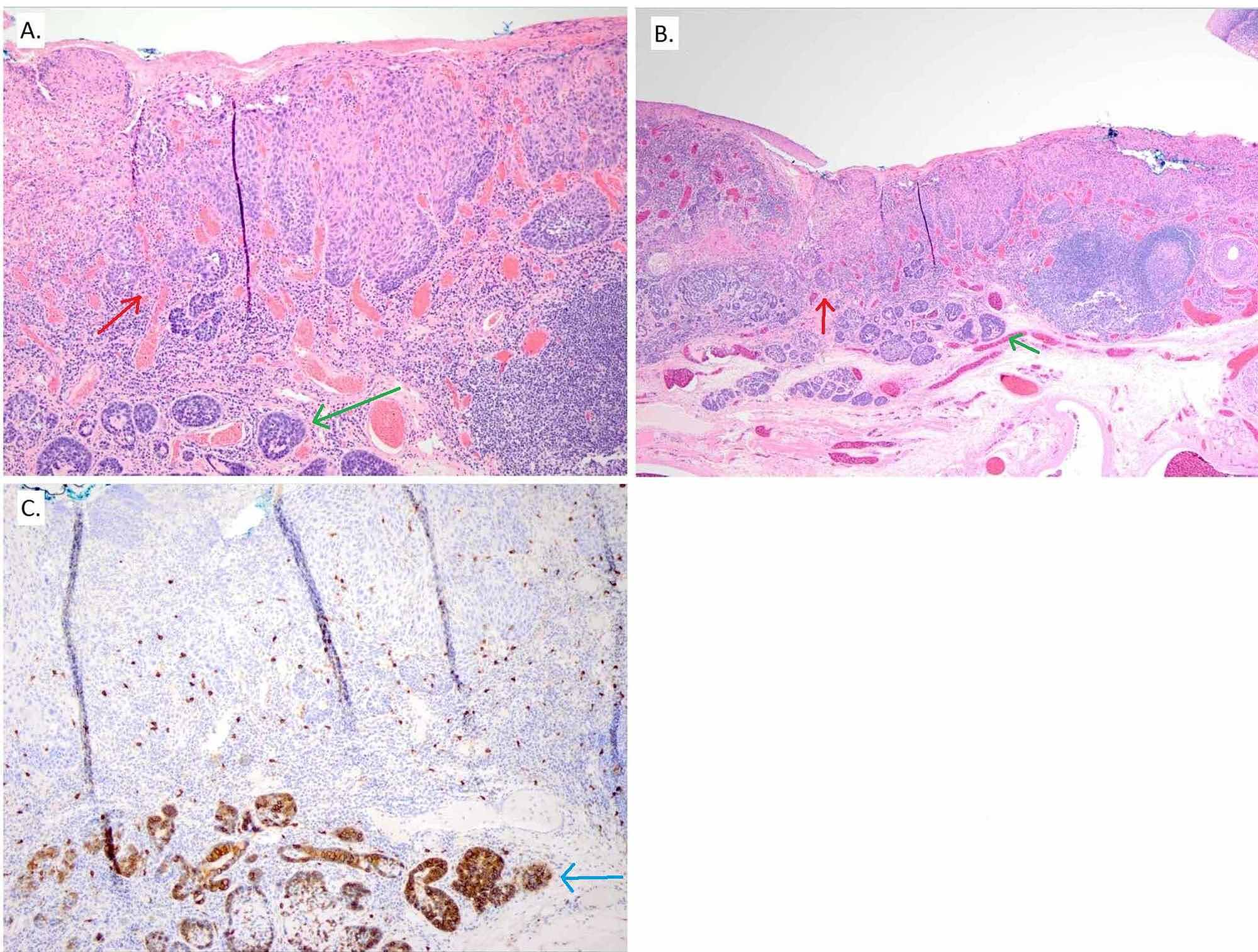 Cureus Squamous Cell and Adenoid Cystic Carcinoma Collision Tumor of