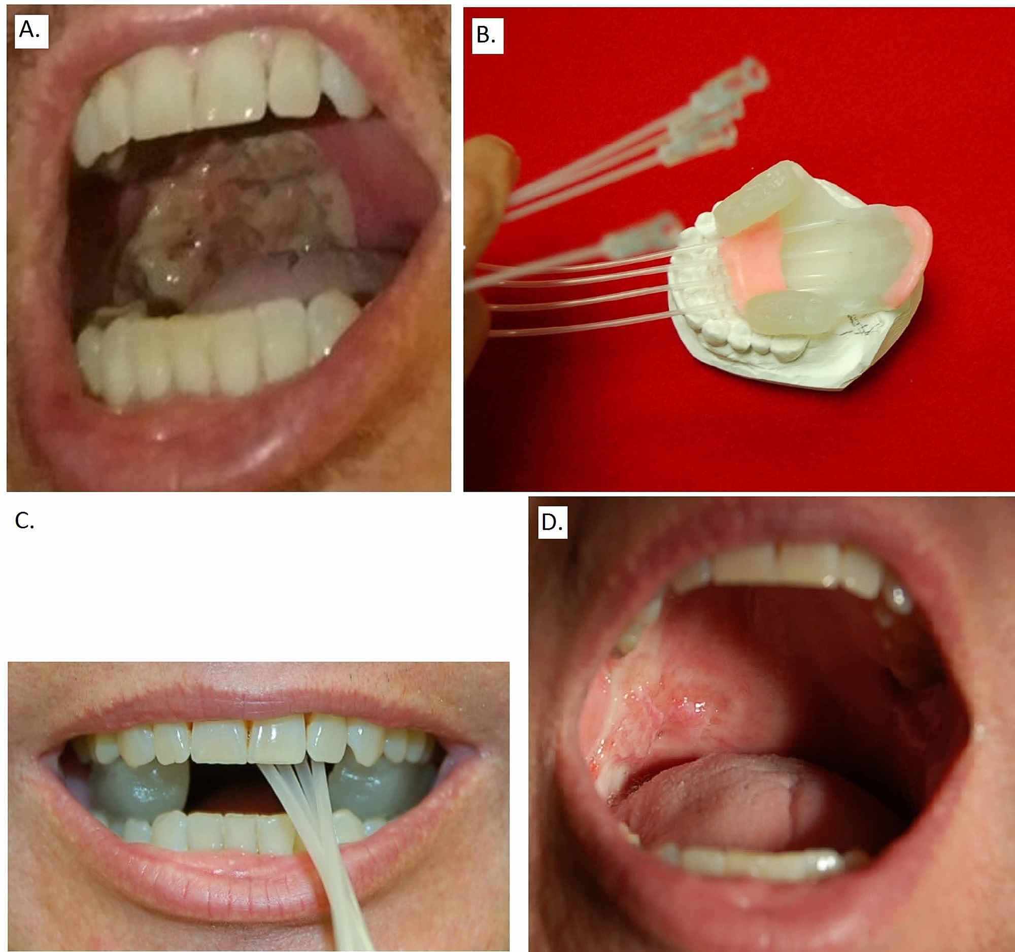 Cureus Squamous Cell and Adenoid Cystic Carcinoma Collision Tumor of