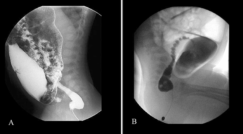 Spot-images-(A-&-B)-of-contrast-enema-showing-an-abnormal-rectosigmoid-index-(<1),-dilated-sigmoid-colon-and-narrow-rectum.