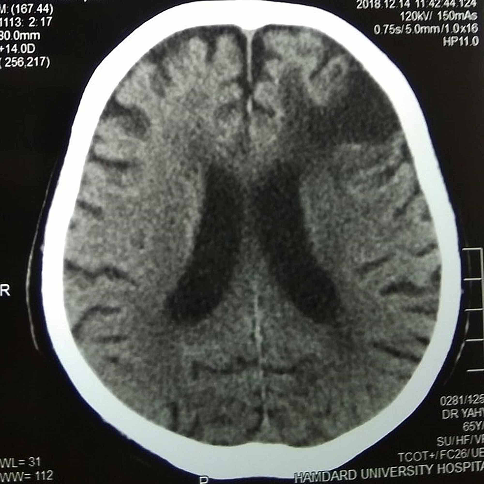 Cureus | Depression As a Consequence of Frontal Lobe Infarction: A Case ...