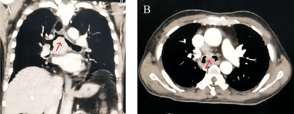 Cureus | Cryodebulking to Relieve Critical Airway Narrowing Due to a ...