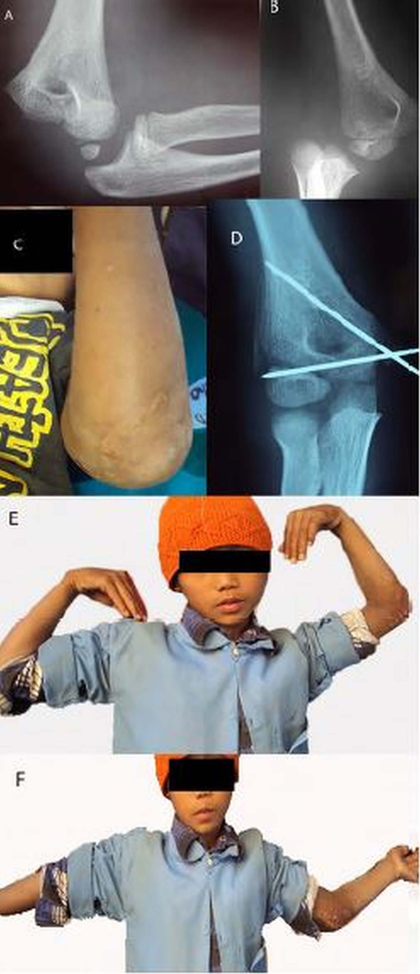 Cureus Radiological And Functional Outcome Of Medial Epicondyle Fracture Treated Surgically In Children And Adolescents A Retrospective Study