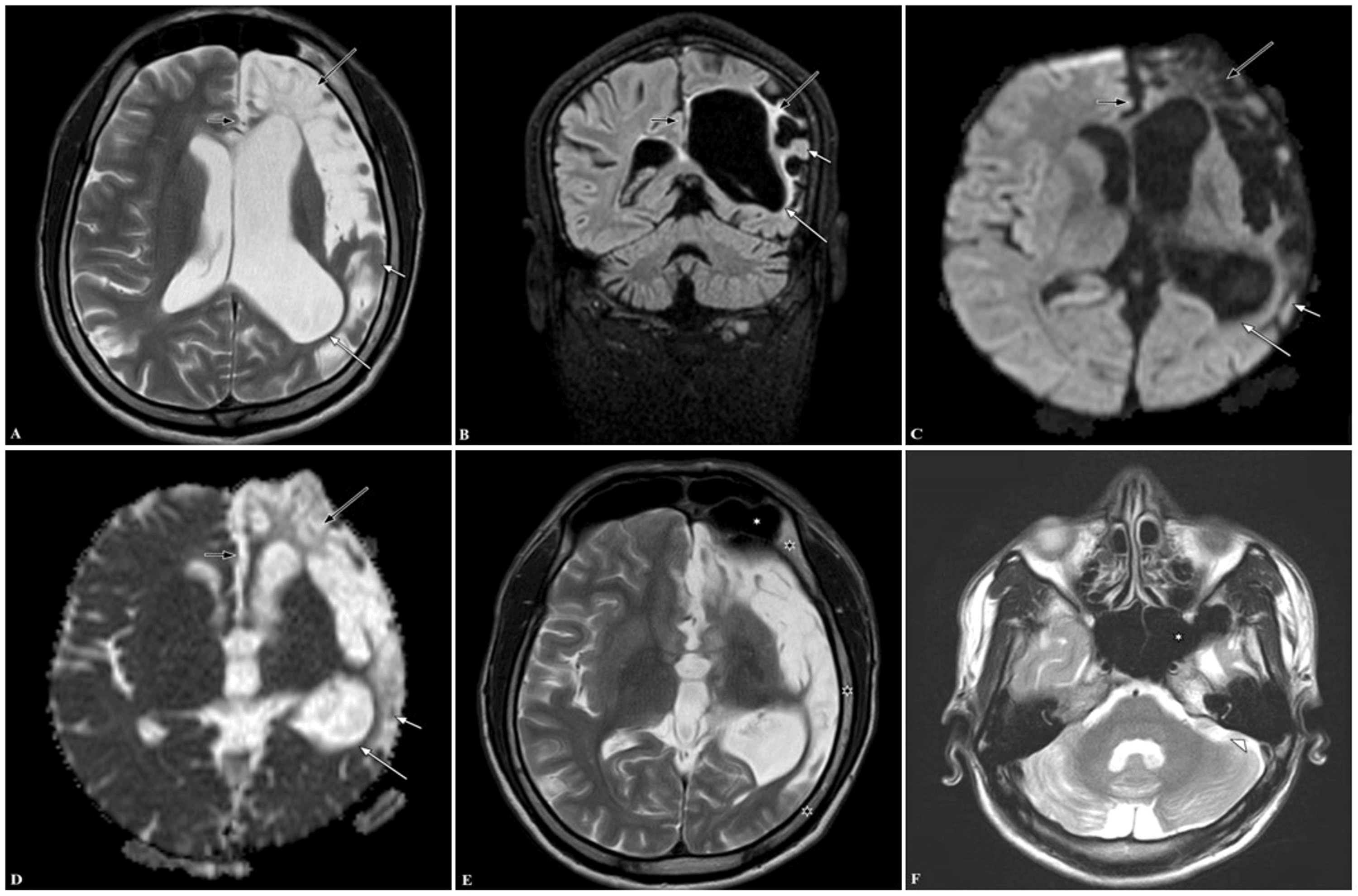 Dyke Davidoff Masson Syndrome As A Rare Cause Of Cerebral Hemiatrophy Insights From A Case 1142