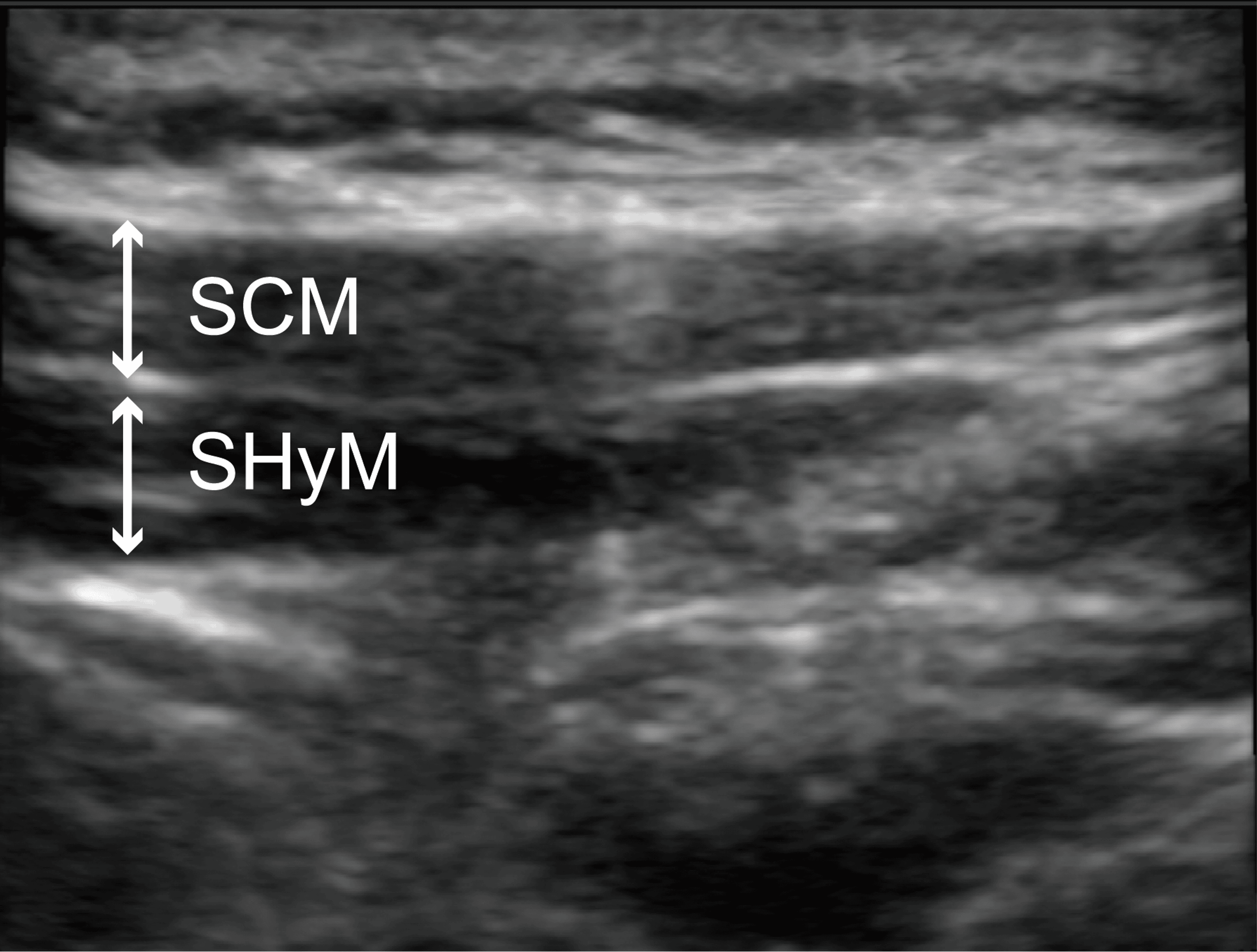 UltrasoundGuided Selective Glossopharyngeal Nerve Block for Severe Gag