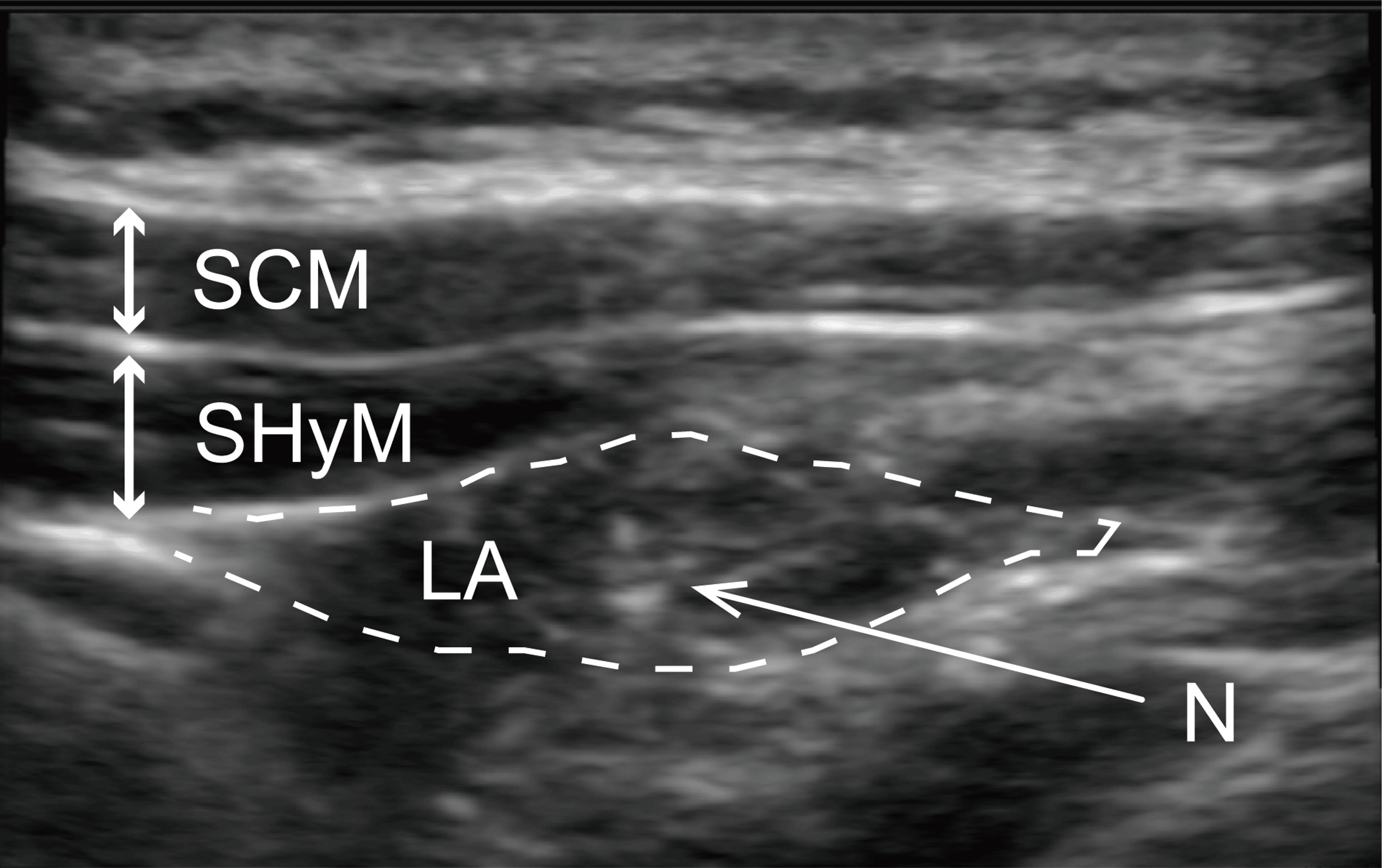 Cureus UltrasoundGuided Selective Glossopharyngeal Nerve Block for