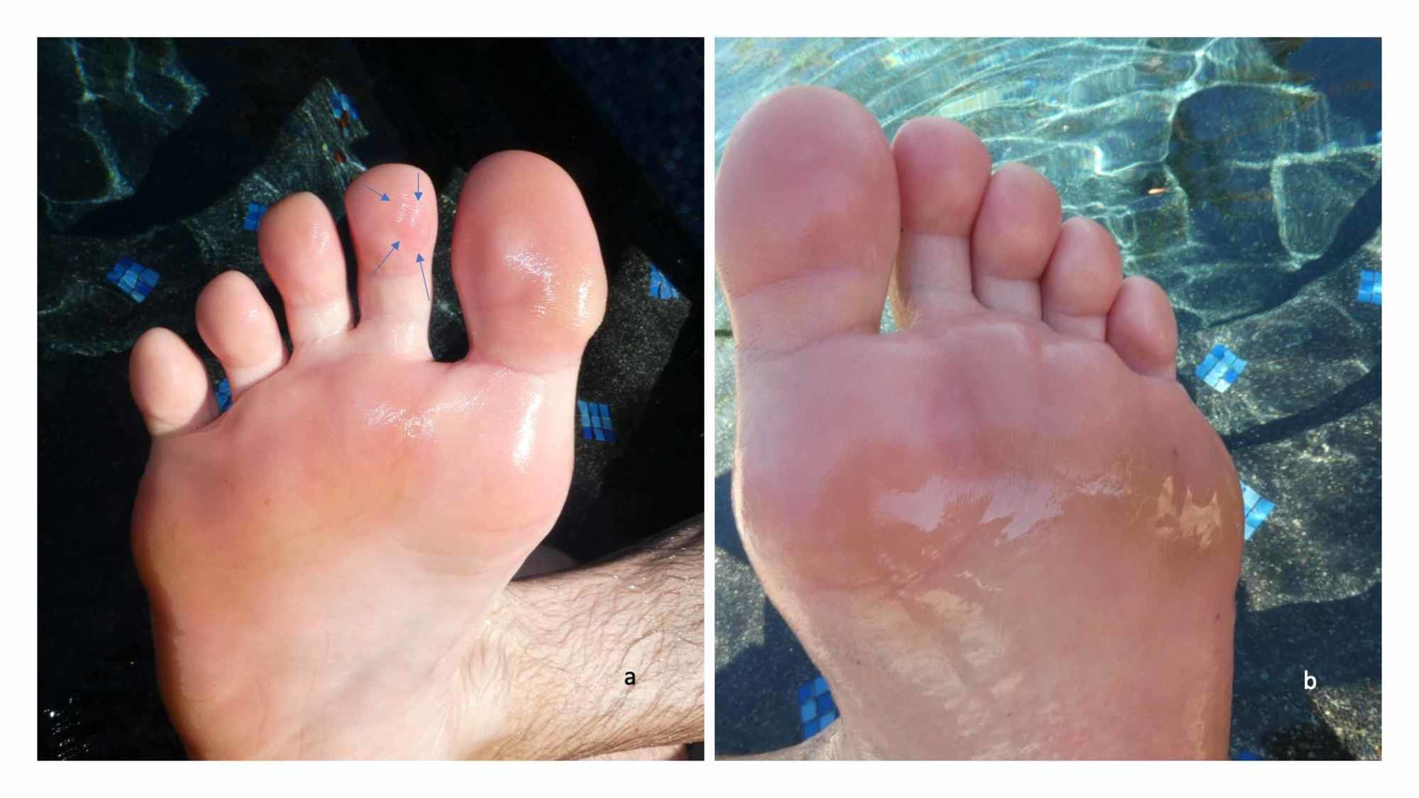 Red Rash On Feet After Beach