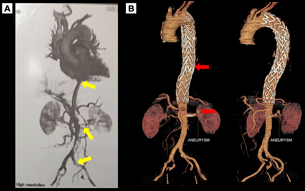 Preoperative-CTA-acute-showing-aortic-dissection-type-B-with-exclusion-of-the-left-kidney,-reduced-lumen-of-the-infrarenal-aorta-and-iliac-arteries,-with-discreet-contrast-filling-of-the-left-iliac-artery-indicated-by-yellow-arrows-(A)-and-three-dimensional-CTA-reconstruction-showing-postoperative-endoprosthesis-placement-and-a-left-renal-artery-aneurysm-marked-by-the-red-arrows-(B).
