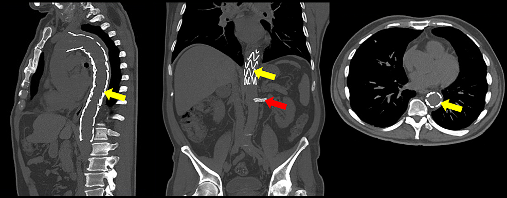 Follow-up-sagittal,-coronal-and-axial-planes-CT-showing-correct-placement-of-the-two-Valiant-type-endoprosthesis-after-the-emergence-of-the-left-subclavian-artery-and-right-above-the-celiac-trunk,-respectively-(yellow-arrows),-and-the-Viabahn-and-Assurant-stents-in-the-left-renal-artery-(red-arrow).
