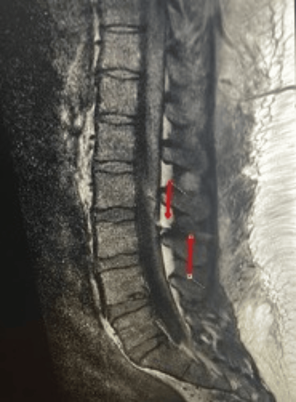 Broken Epidural Catheter After Vaginal Delivery Cureus