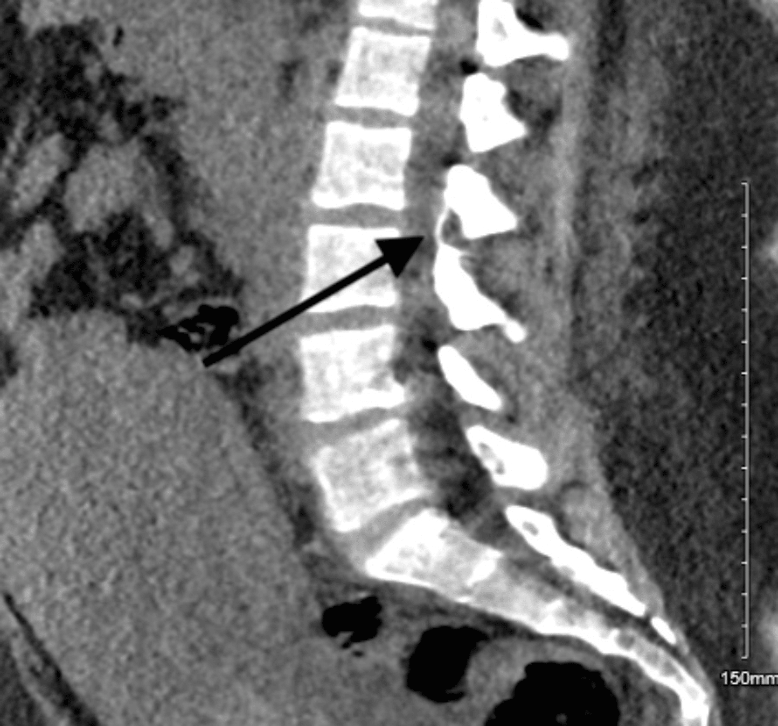 Broken Epidural Catheter After Vaginal Delivery Cureus