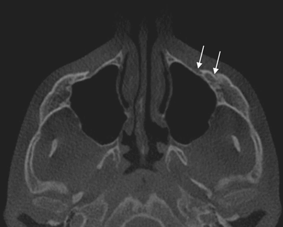 Cureus | The Infraorbital Foramen in a Sample of the Lebanese ...