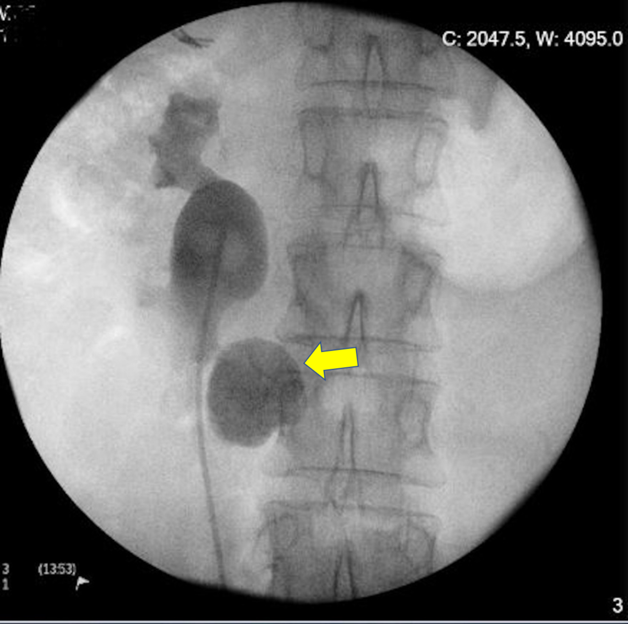 Cureus Laparoscopic Nephrolithotomy in a Horseshoe Kidney