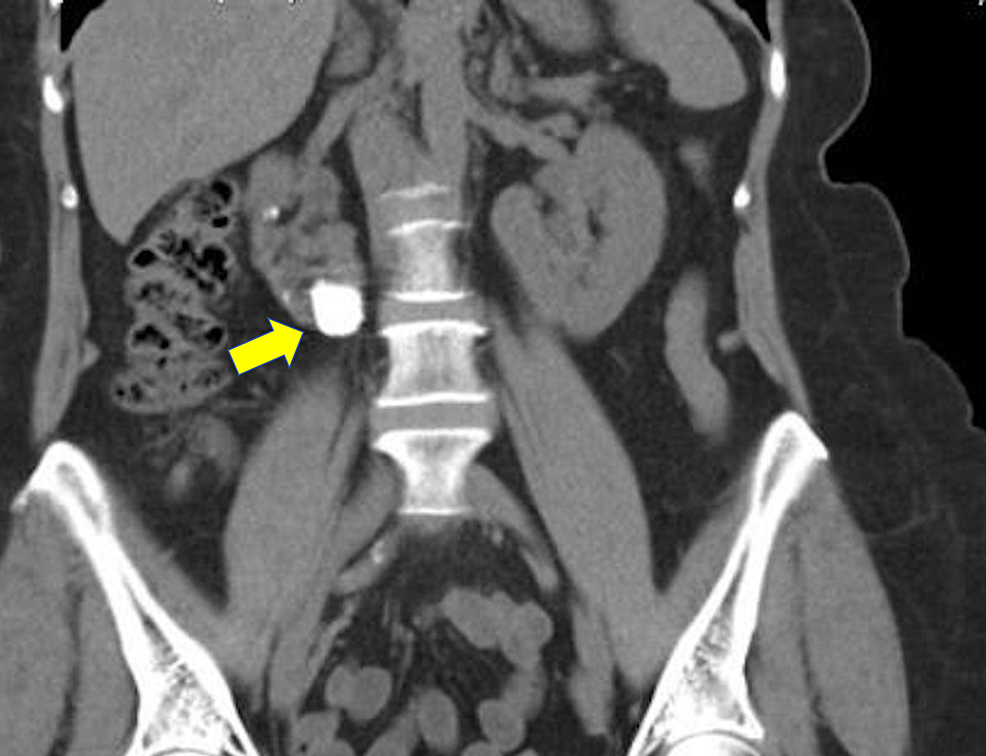 Cureus Laparoscopic Nephrolithotomy in a Horseshoe Kidney