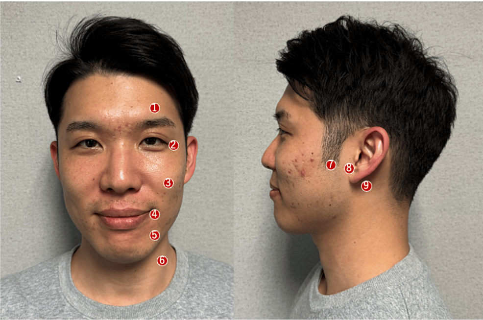 Cureus Weekly Acupuncture for a Patient With Hemifacial Spasms A