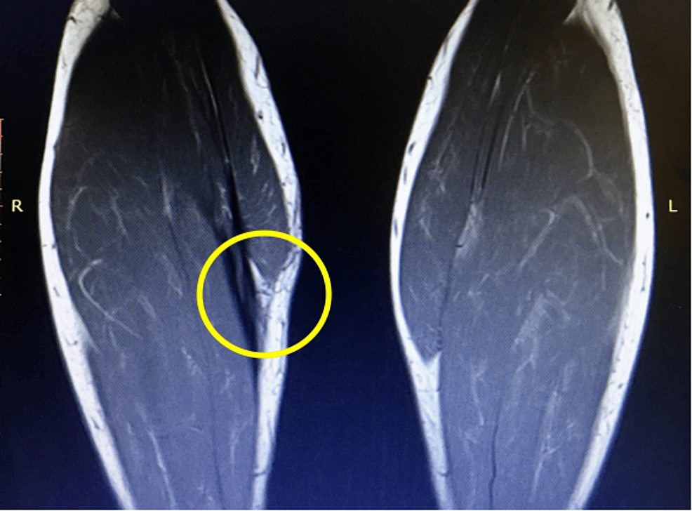 Cureus A Novel Surgical Technique for the Reconstruction of Chronic