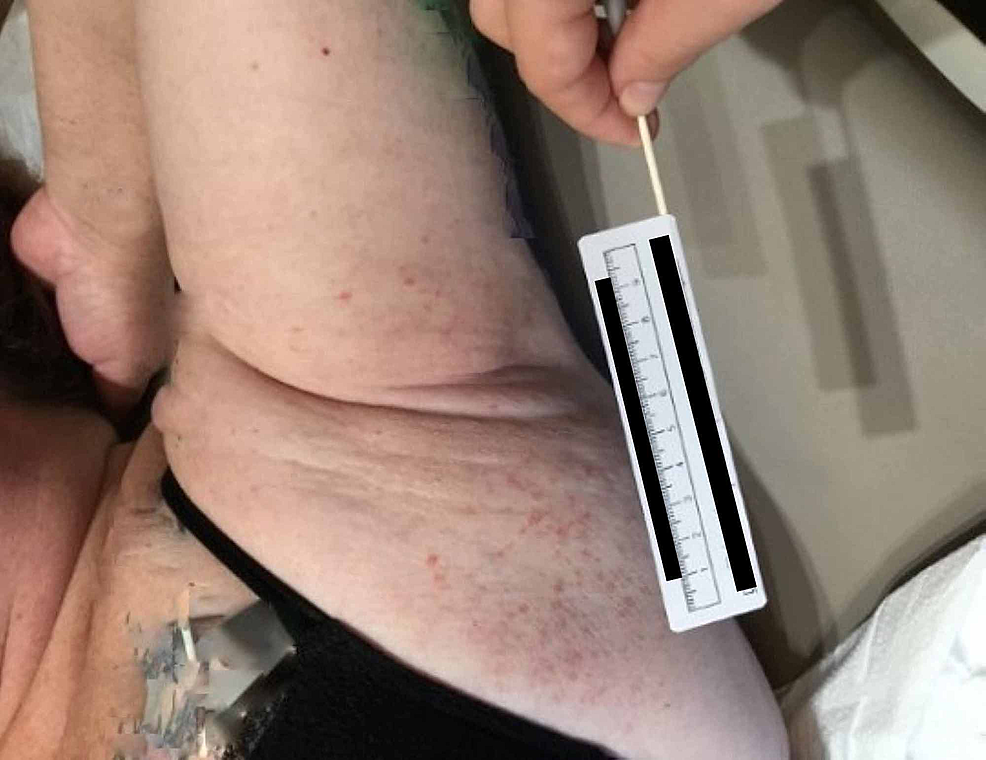 Patient’s-left-axilla-demonstrates-the-papular-eruption-extending-from-her-axillary-vault-to-her-inframammary-tissue-(patient’s-tattoos-have-been-digitally-altered-to-maintain-anonymity)