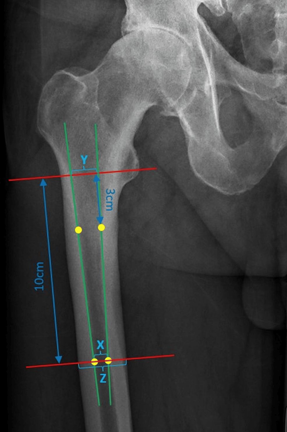 Cureus | Bone Quality Assessment Before Total Hip Arthroplasty: The ...