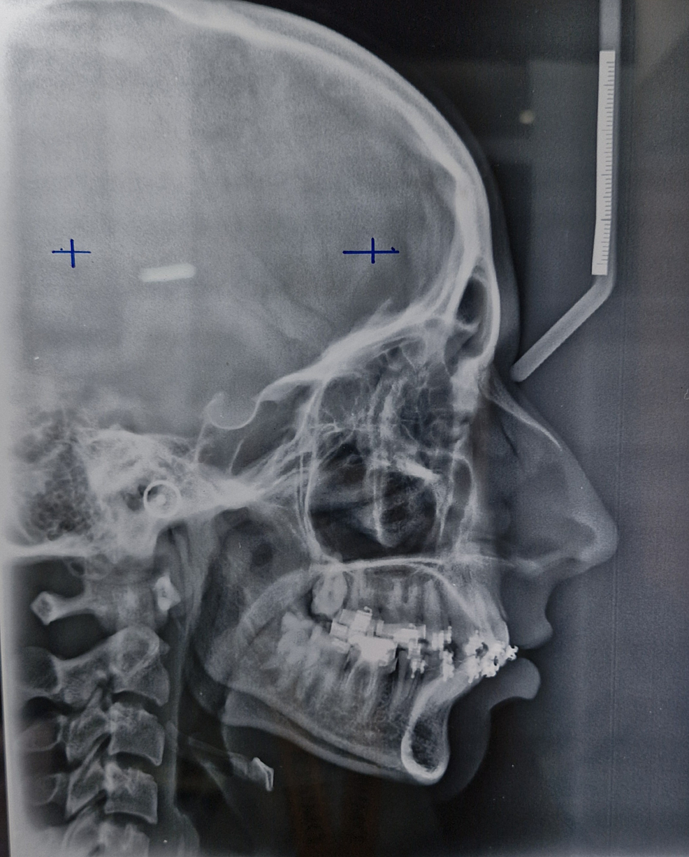 Cureus Simultaneous Intrusion and Retraction of Maxillary Anterior