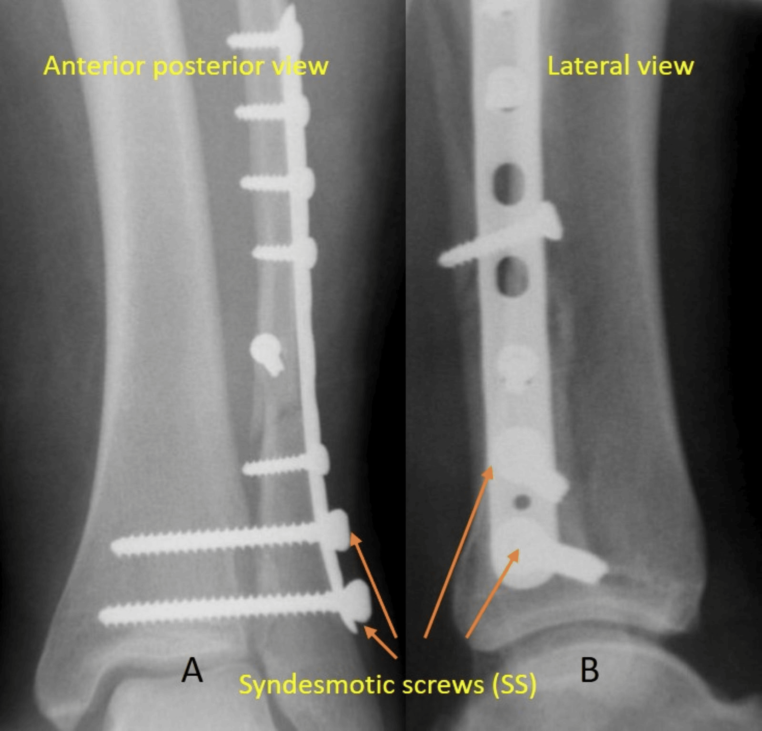 Surgical Outcomes Of Syndesmotic Fixation Of Ankle Fractures Using ...