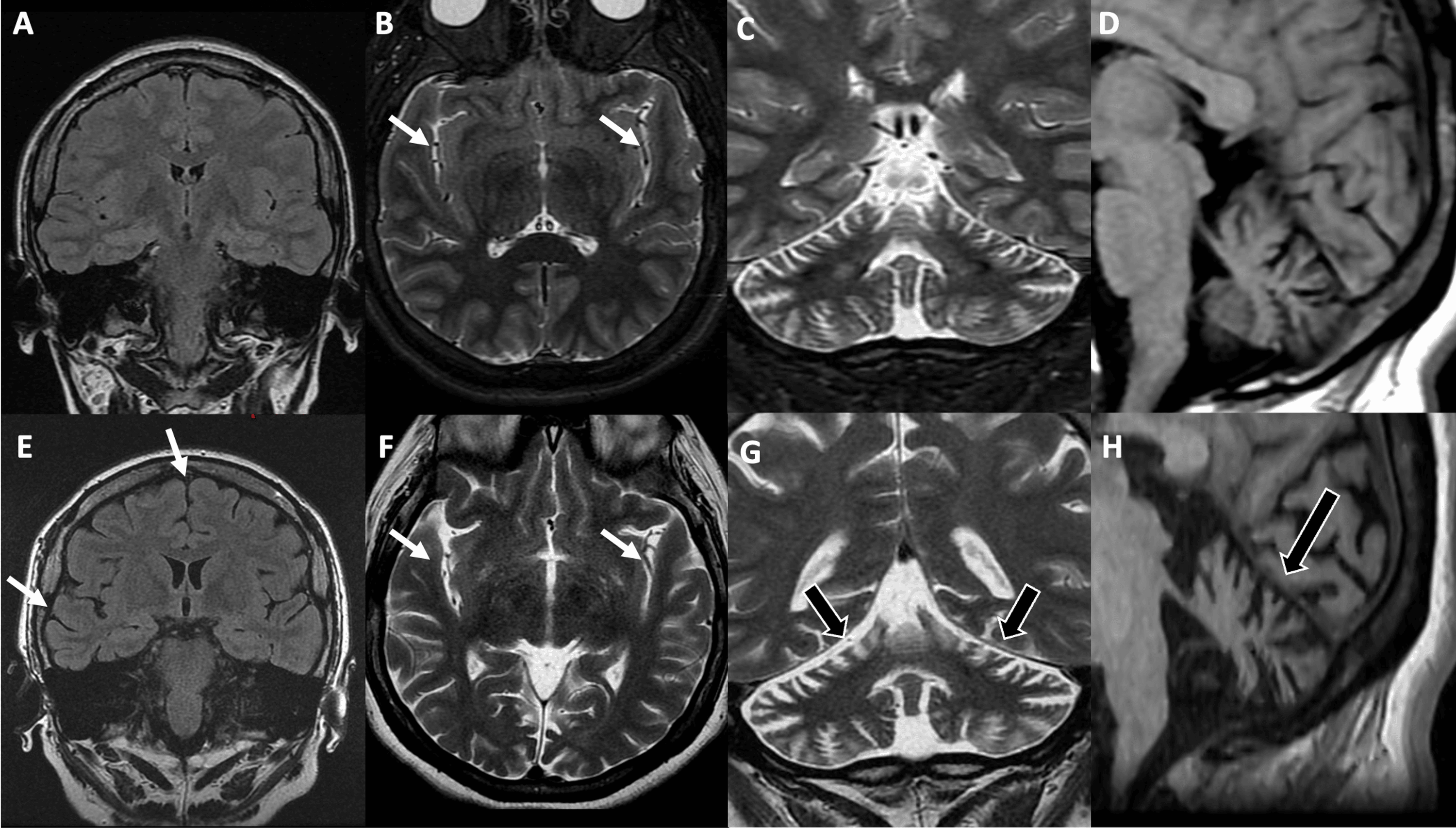 Recognizing Lipofuscinosis As A Guide In Antiepileptic Treatment