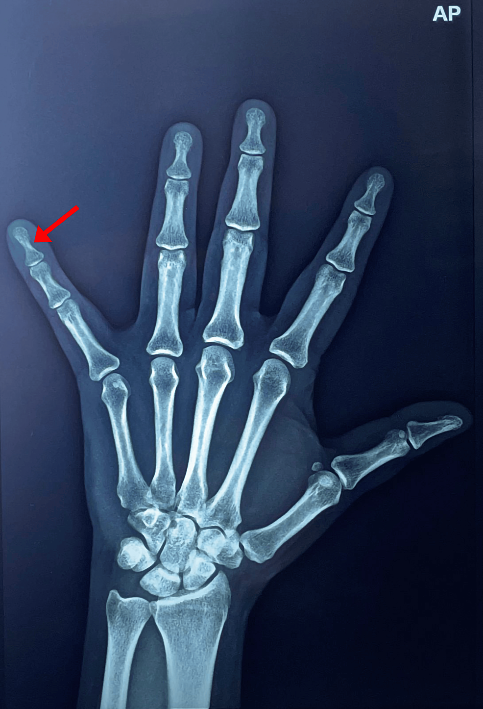 Glomus Tumour in the Fingers