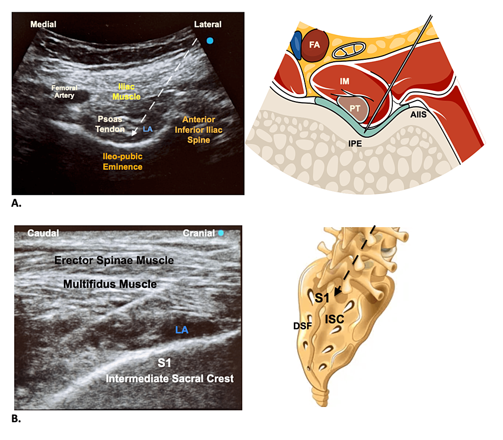 Combination Of Pericapsular Nerve Group Peng And Sacral Erector Spinae Plane S Esp Blocks