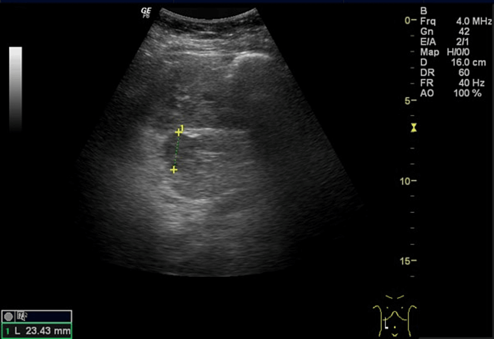 Cureus Pheochromocytoma During Pregnancy A Hidden Cause For Hypertension 1590