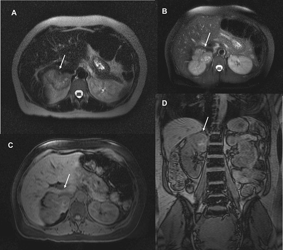 Cureus Pheochromocytoma During Pregnancy A Hidden Cause For Hypertension 8445