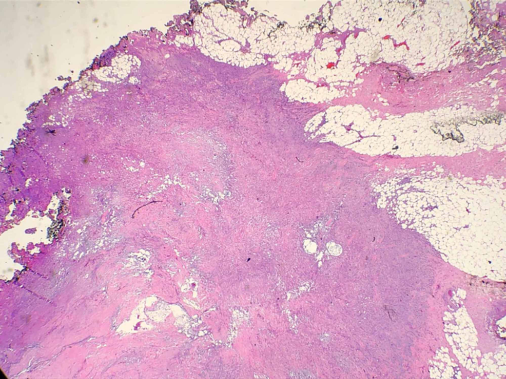 Giant Ulcerative Basal Cell Carcinoma with Local Metastasis A Case