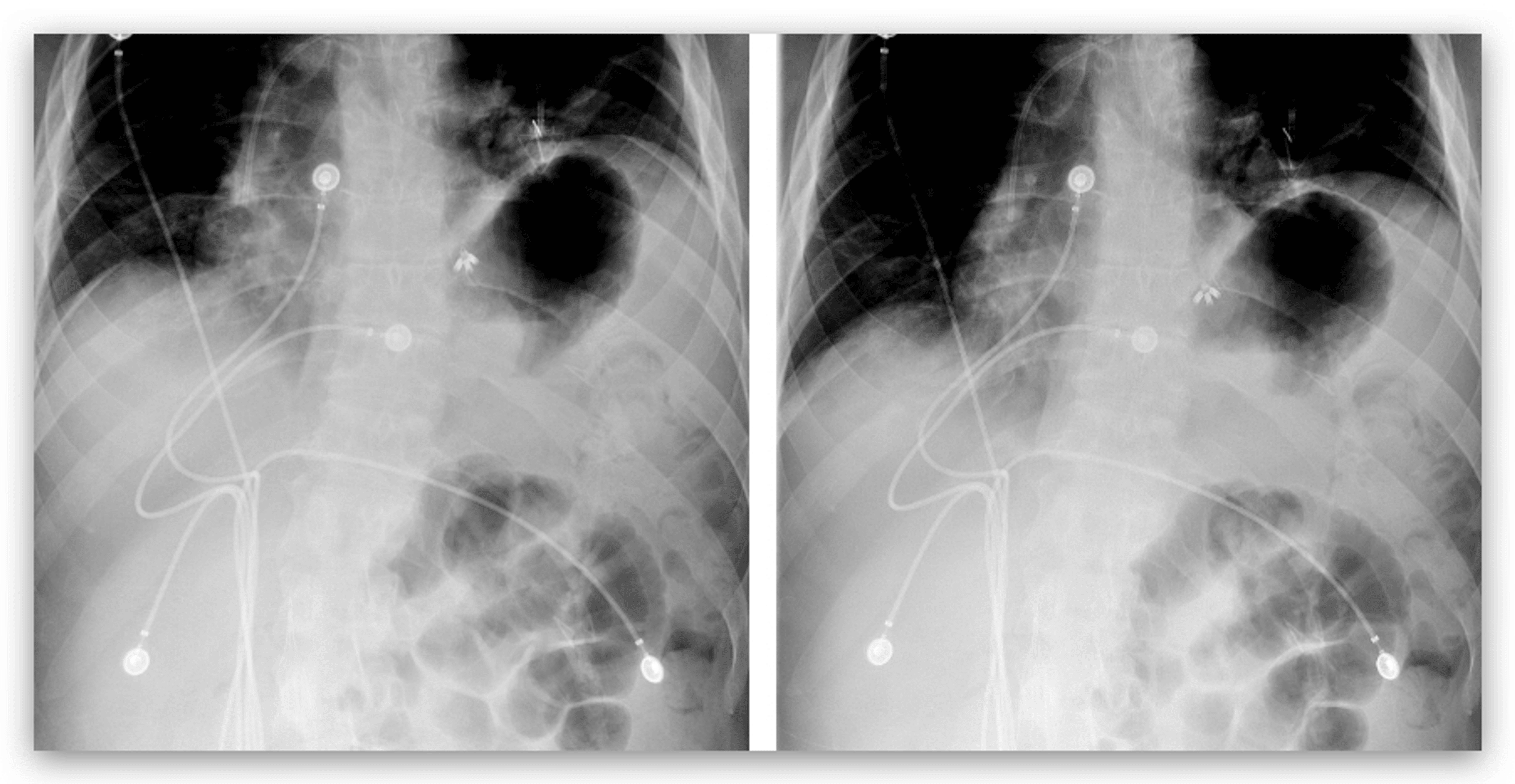 Unilateral Diaphragmatic Paralysis A Case Report of an Often