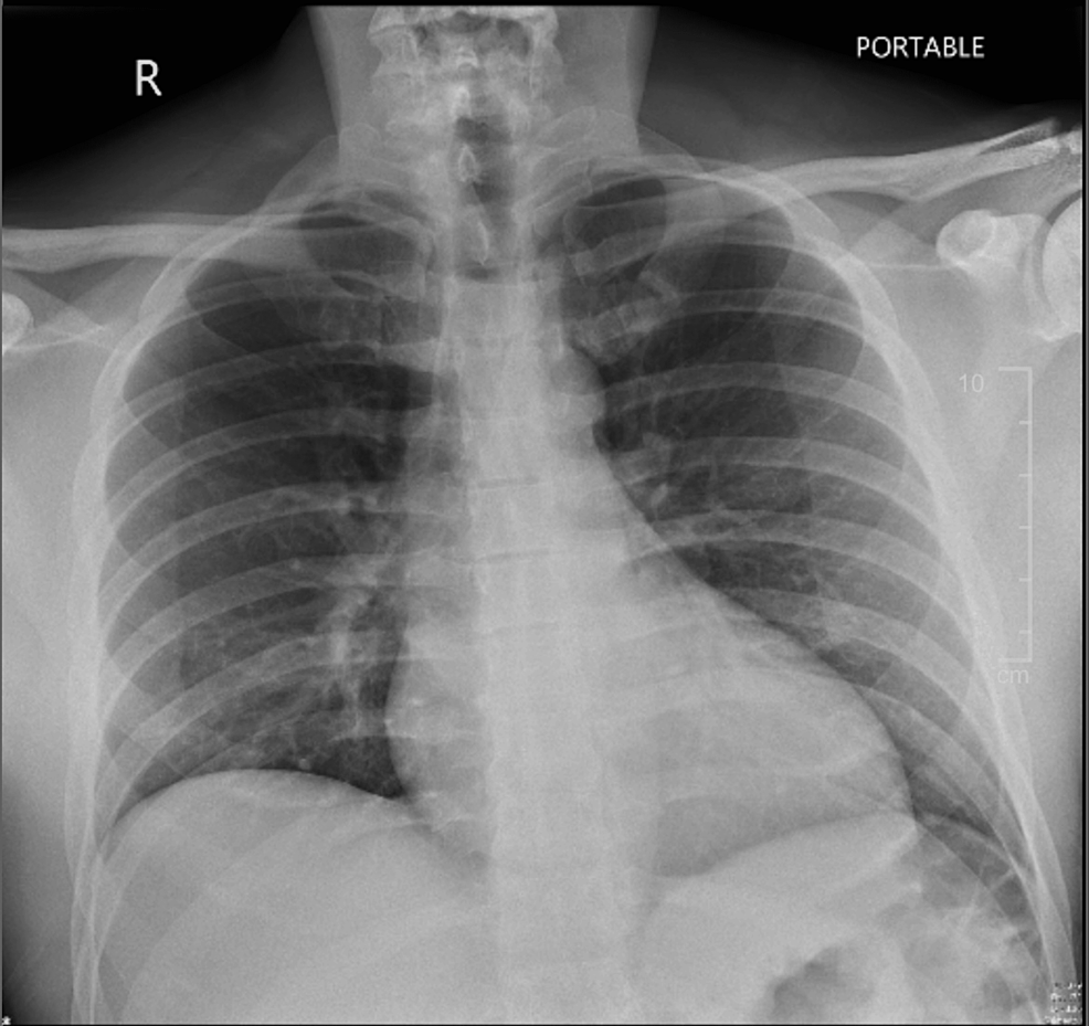 Recurrent Isolated Uvular Angioedema Associated With Intranasal Cocaine ...