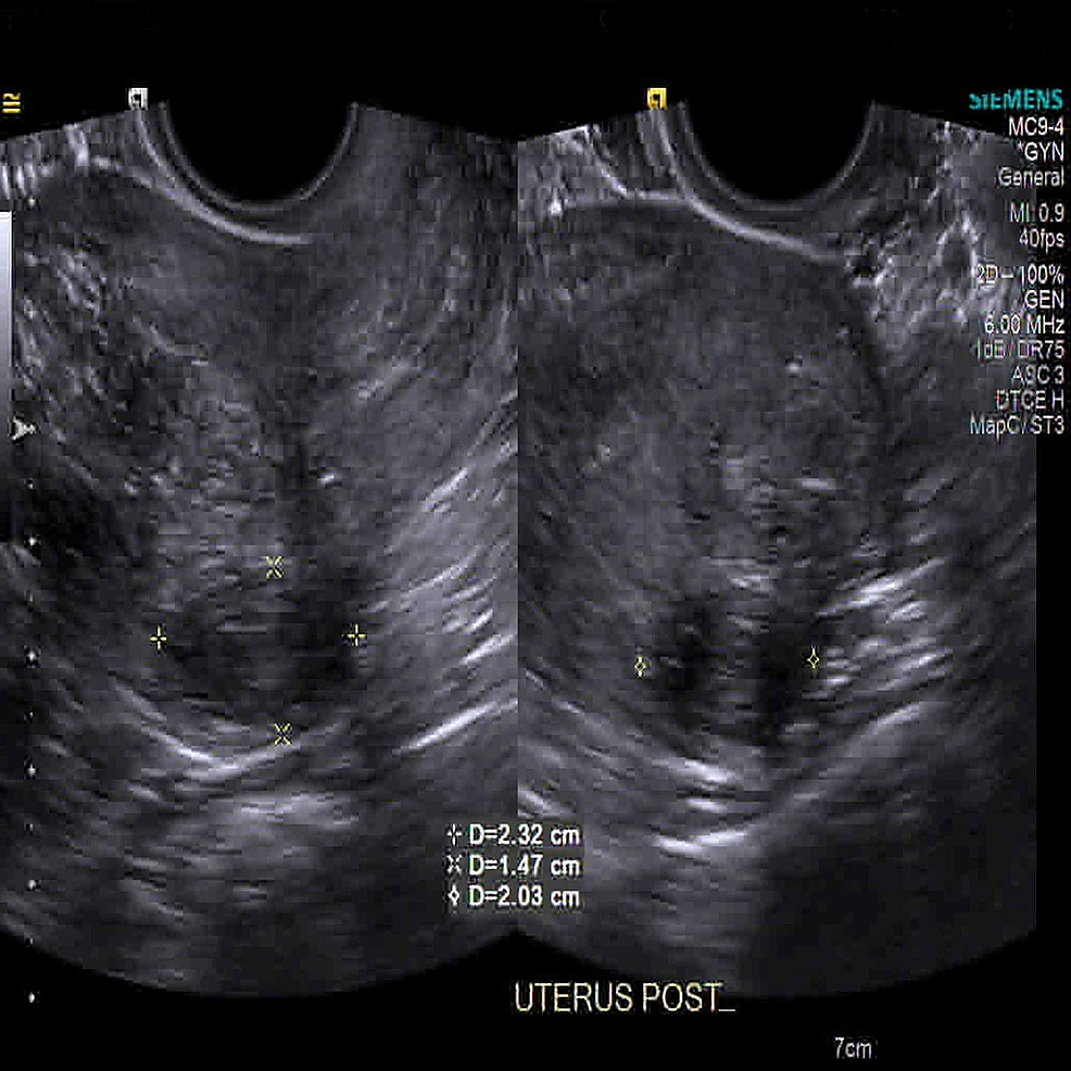 Cureus | A Rare Case of Severe Starvation-induced Ketoacidosis in a ...