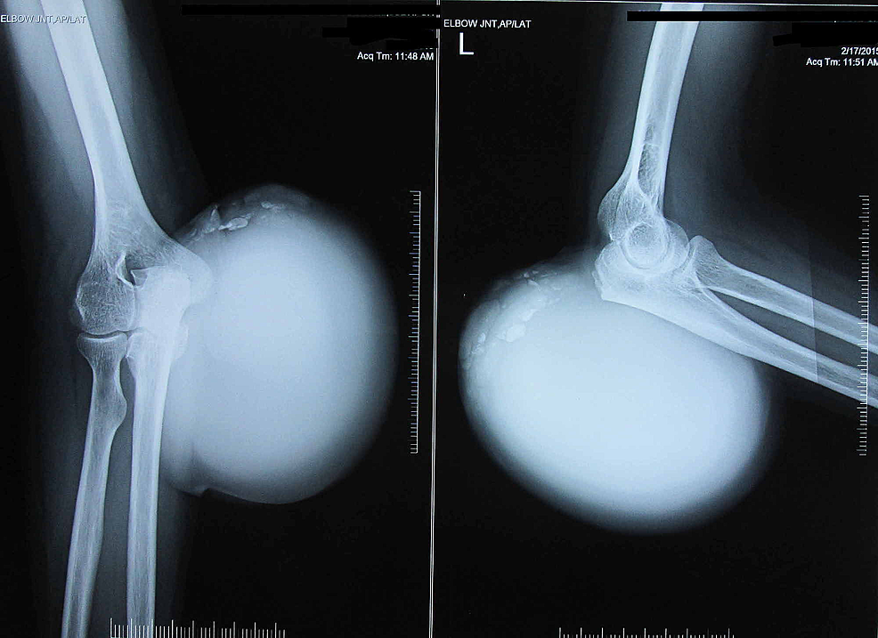 Cureus Massive Gouty Tophi Presenting as Pseudotumor of the Elbow A