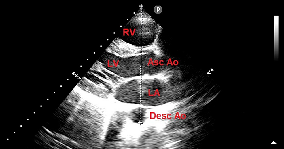 Cureus, Is It Possible to Predict False-Positive Exercise Stress  Echocardiography Results by Measuring the Left Atrial Antero-Posterior  Diameter?