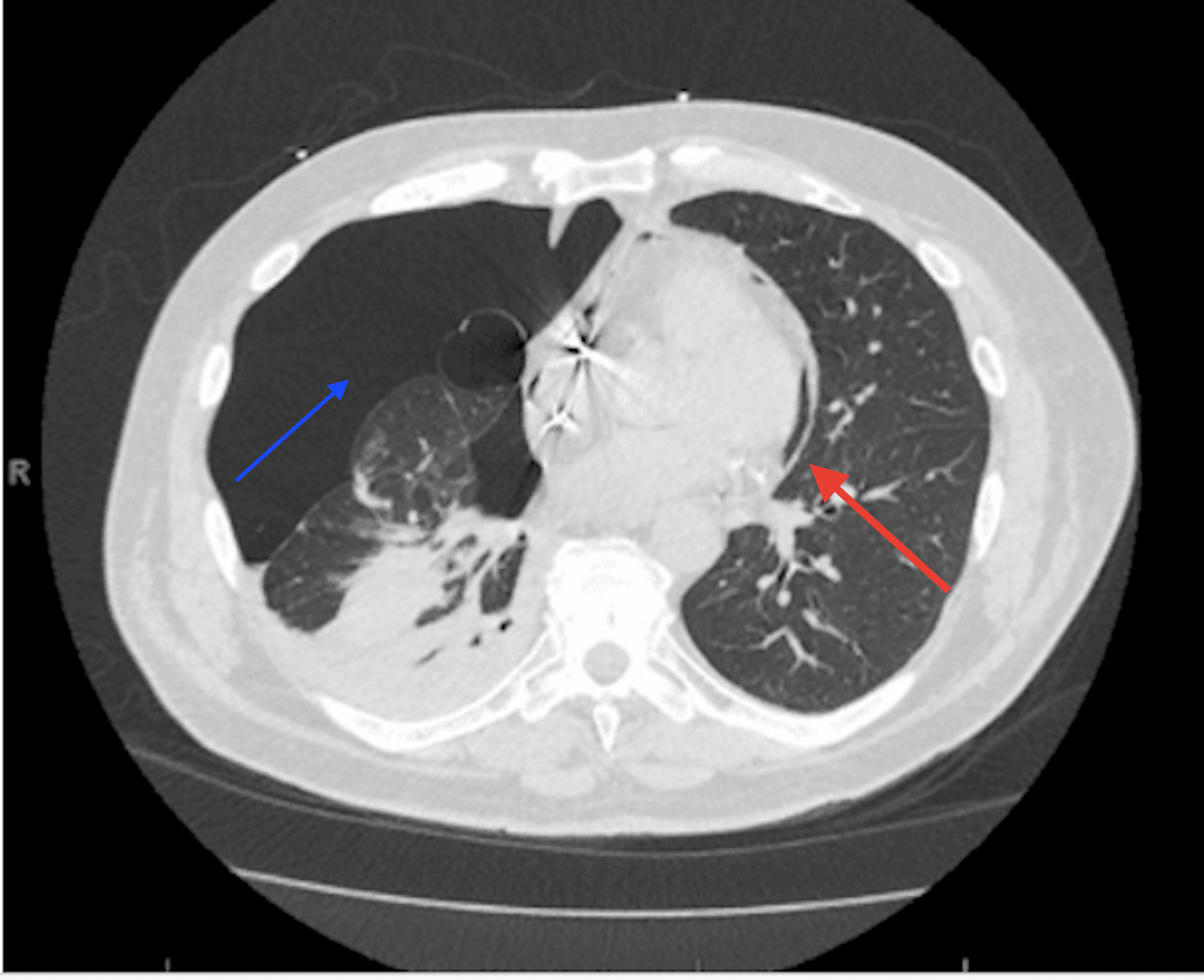 Traumatic Right Atrium Perforation Causing a Pneumothorax and ...