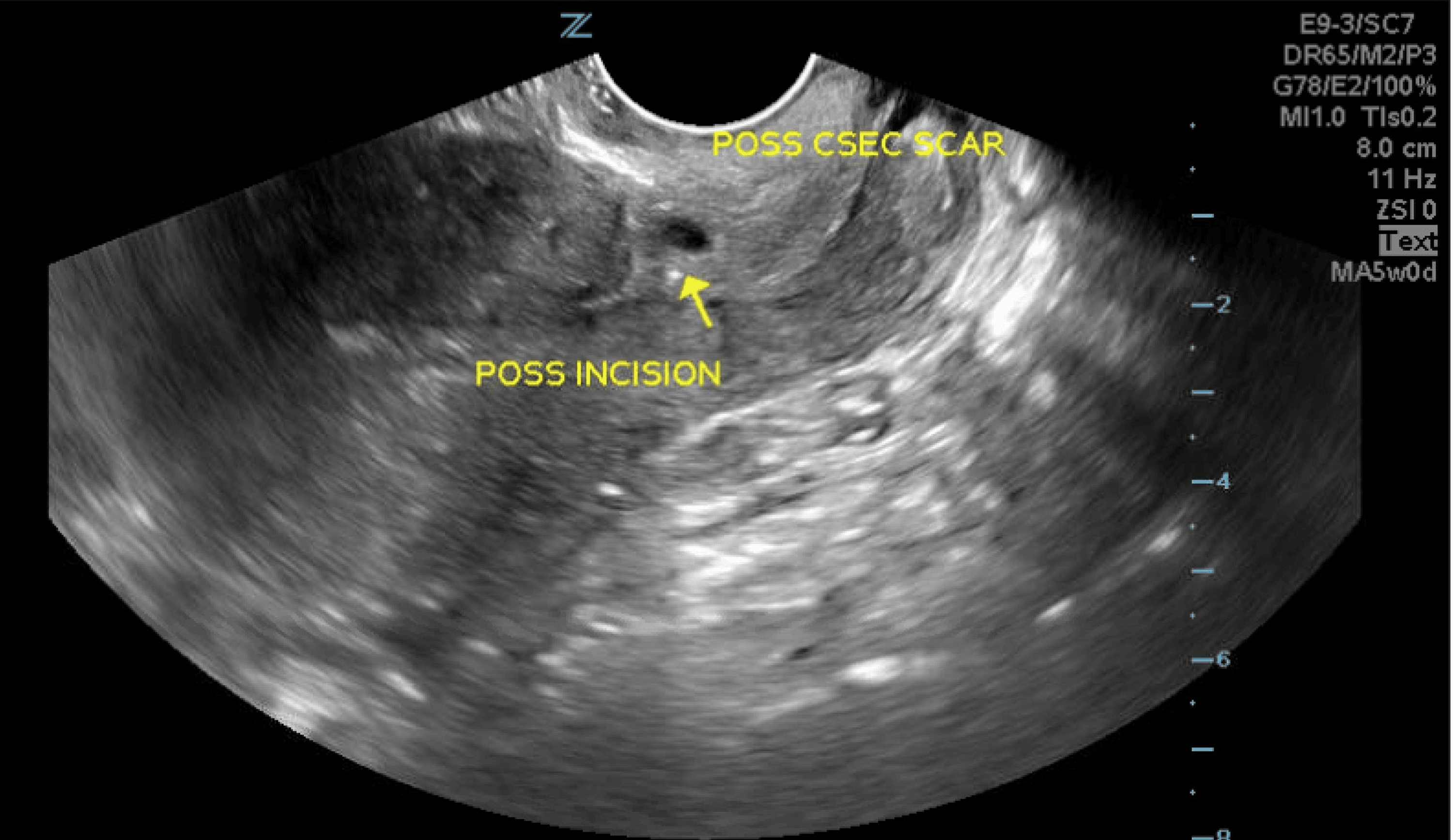 Cesarean Scar Pregnancy With Surgical and Conservative Managements: A ...