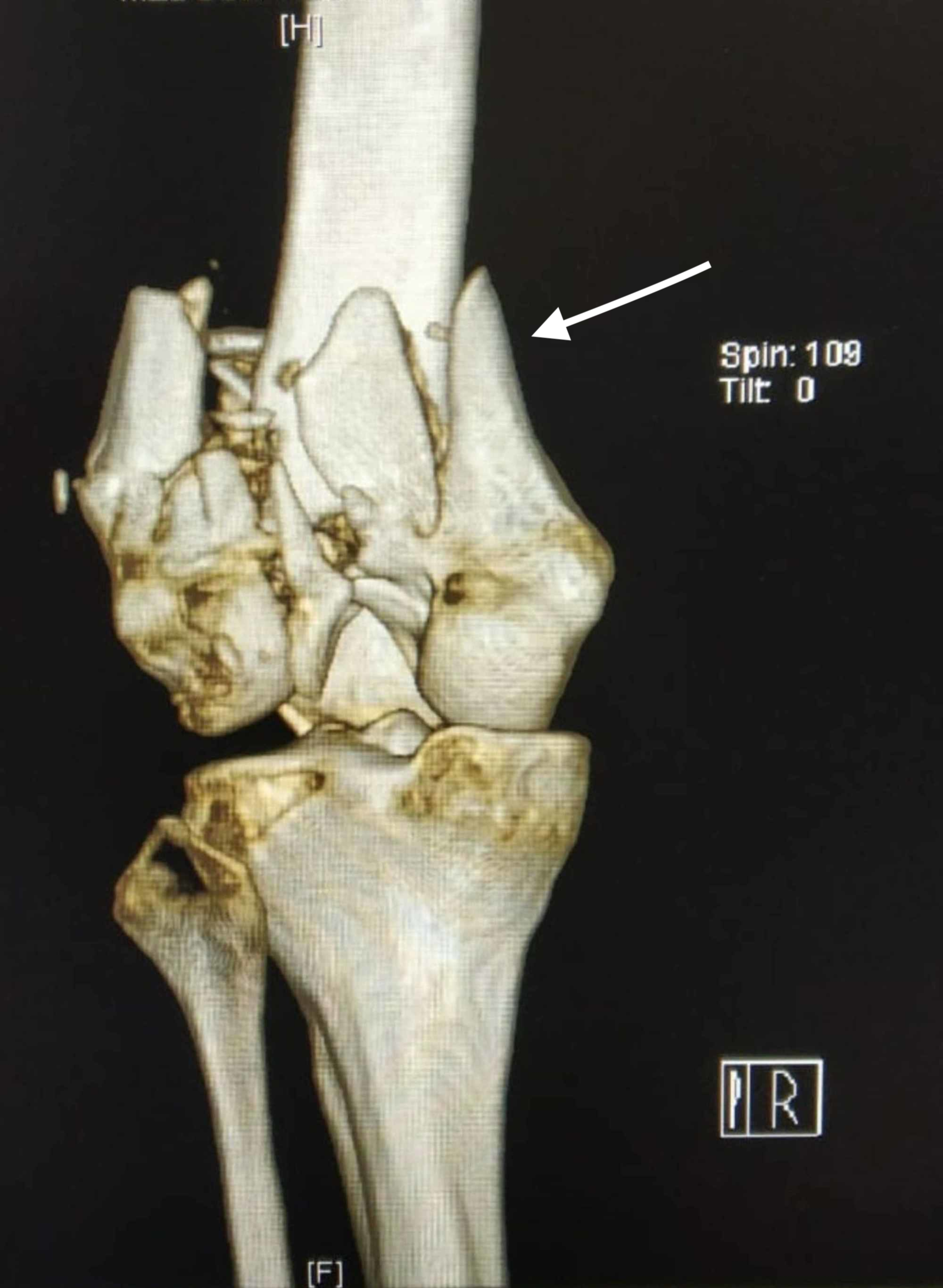 femur bone fracture