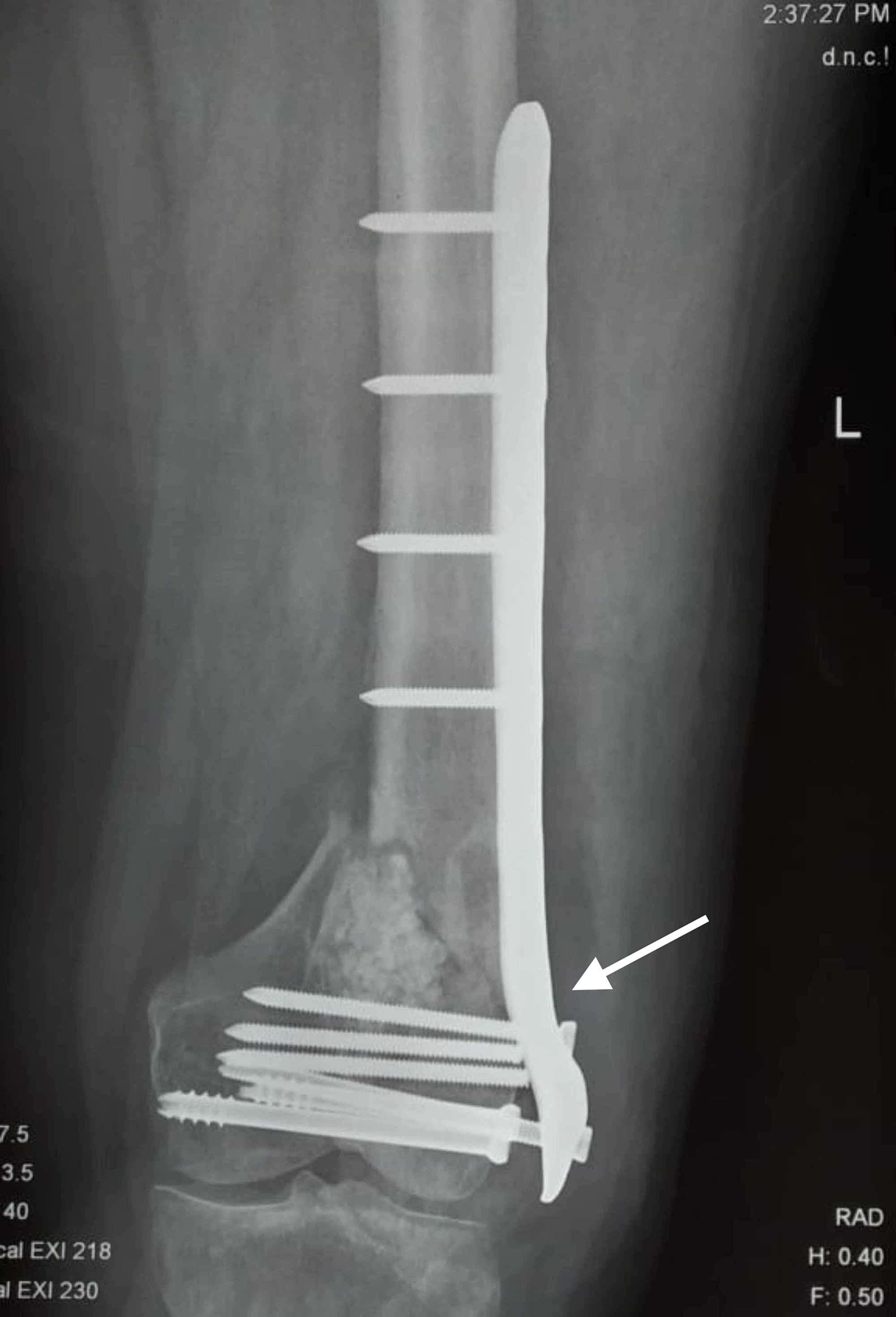 Cureus Dual Plating Of The Distal Femur Indications And Surgical Techniques