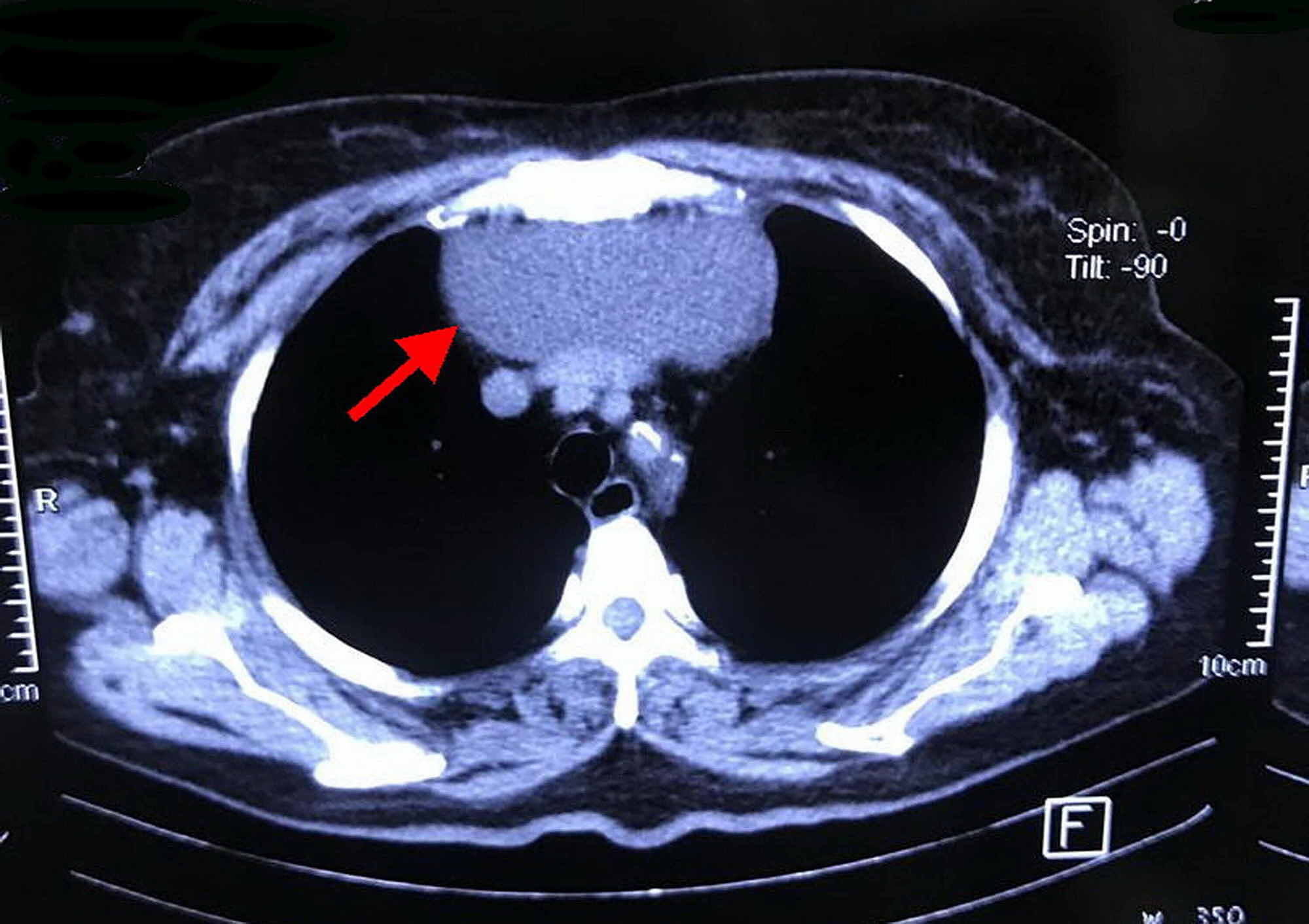 Cureus Huge Mediastinal Thymic Cyst in the Elderly Patient
