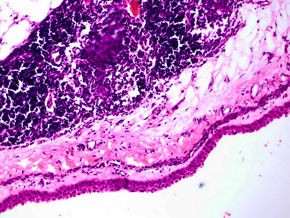 Cureus Huge Mediastinal Thymic Cyst in the Elderly Patient