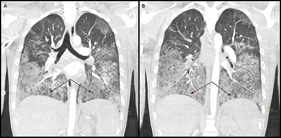 e cigarette induced lung injury Diffuse Alveolar Hemorrhage: An Uncommon Manifestation of Vaping-associated  Lung Injury
