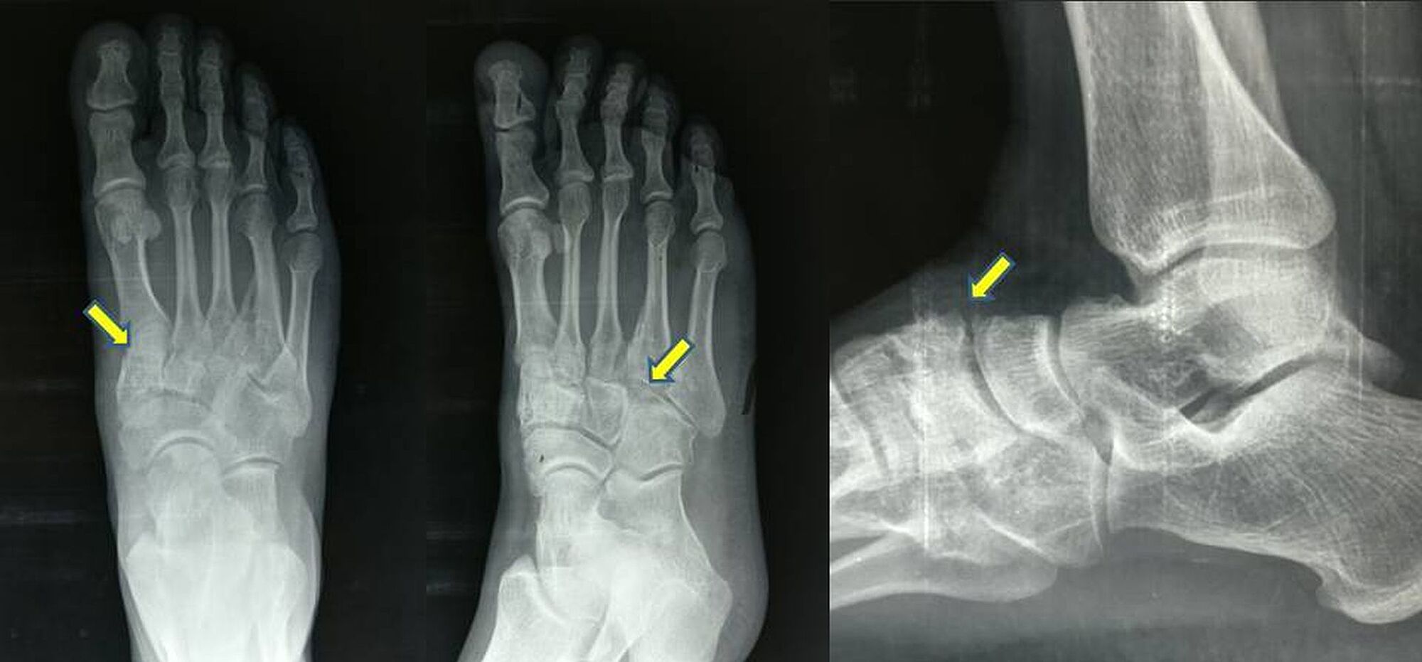 Cureus | Post-traumatic Arthritis of the Tarsometatarsal Joint Complex