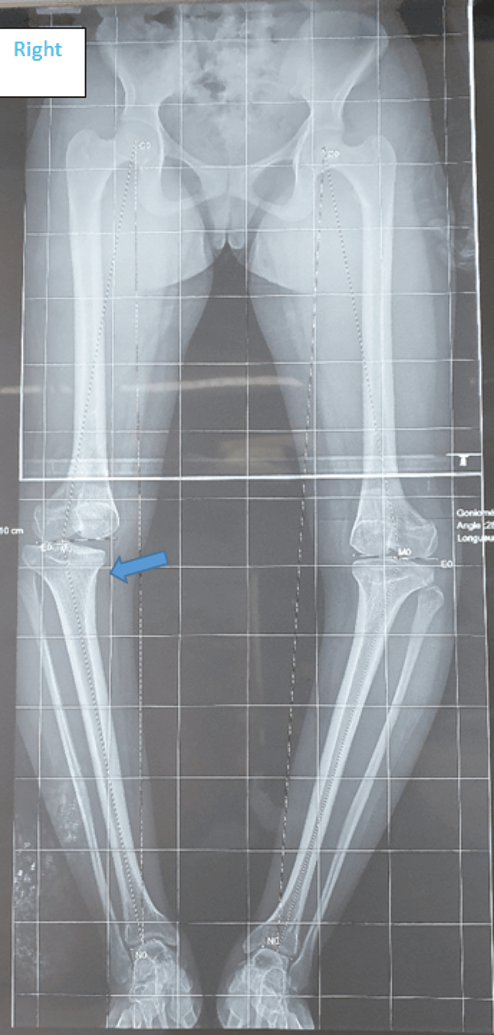 Cureus Bilateral Inverted V Shaped High Tibial Osteotomy A Case Report