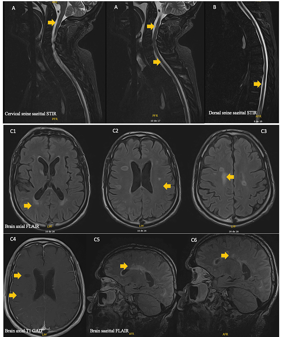 Cureus | Guillain-Barré Syndrome After a SARS-CoV-2 Vaccine