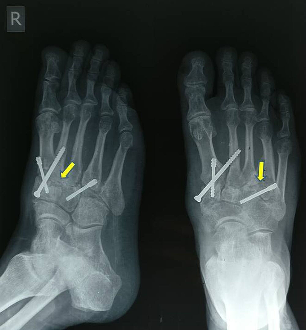 Cureus Posttraumatic Arthritis of the Tarsometatarsal Joint Complex
