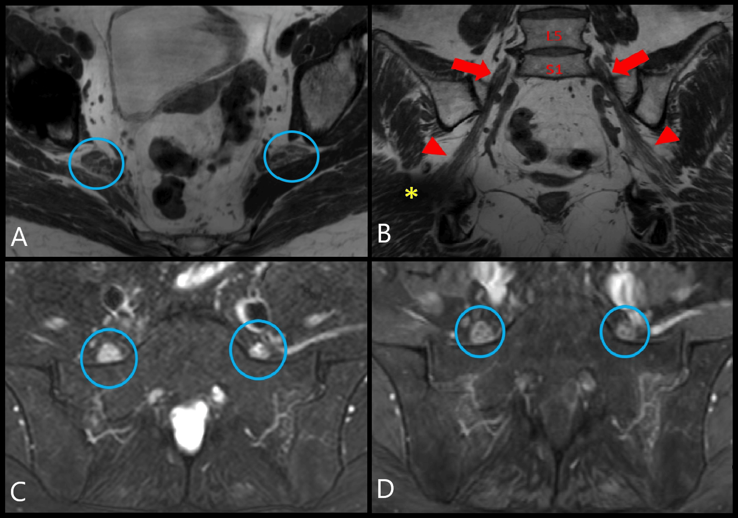 Bilateral Lumbosacral Plexopathy As the Initial Manifestation of ...